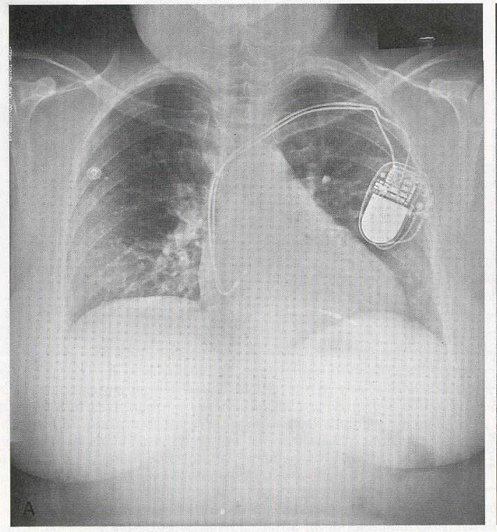 Radiographie de thorax de face montrant un boîtier de stimulateur cardiaque en région pectorale gauche et deux sondes suivant le trajet veineux sous-clavier.