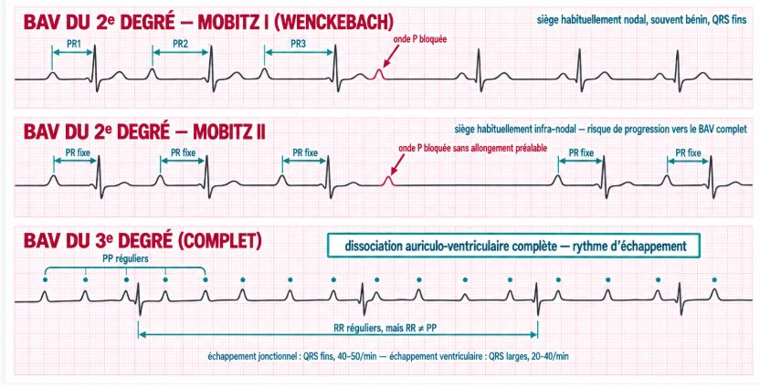 Quatre tracés ECG schématiques illustrant BAV du premier degré, Mobitz I, Mobitz II et BAV complet.