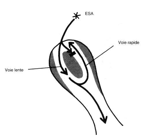 Schéma au trait du nœud auriculo-ventriculaire montrant la double voie de conduction, une extrasystole auriculaire bloquée dans la voie rapide et le circuit de réentrée qui en résulte.