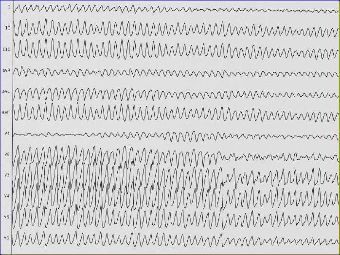 Enregistrement électrocardiographique douze dérivations d'une fibrillation ventriculaire : oscillations continues et anarchiques, sans complexe identifiable ni ligne isoélectrique.