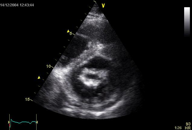 Coupe échocardiographique parasternale petit axe au niveau de la valve mitrale montrant l'orifice mitral rétréci vu de face, tel qu'il est tracé pour la planimétrie.