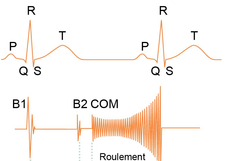 Schéma didactique superposant un tracé ECG à deux cycles et le phonocardiogramme correspondant, avec B1, B2, le claquement d'ouverture mitral et le roulement diastolique à renforcement présystolique.
