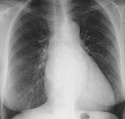 Radiographie thoracique de face montrant la silhouette cardiomédiastinale et les champs pulmonaires, utilisée ici comme exercice de repérage des signes radiologiques du rétrécissement mitral, le double contour du bord droit n'y étant pas identifiable.