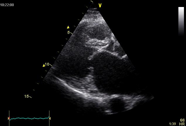 Coupe échocardiographique parasternale grand axe montrant le bombement en genou fléchi du grand feuillet mitral en diastole, signe évocateur de rétrécissement mitral.