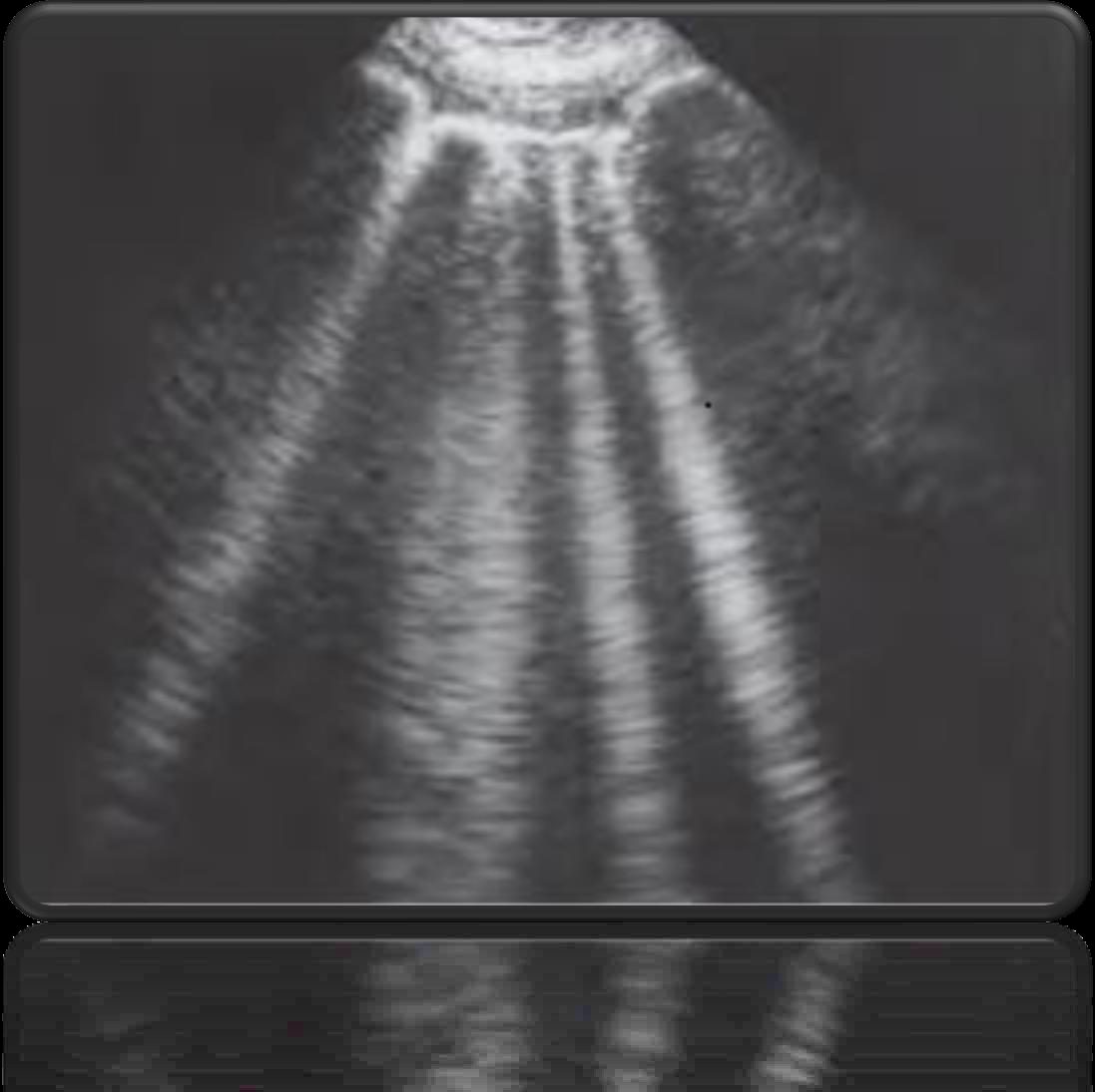 Figure 2 — Fusees pleurales : multiples lignes B verticales confluentes nees de la plevre, traduisant le syndrome alveolo-interstitiel qui evolue vers le « poumon blanc ».
