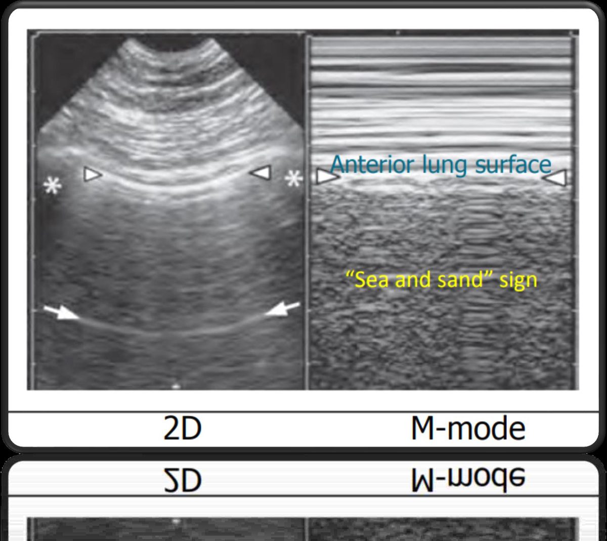 Figure 5 — Poumon normal : en mode temps-mouvement (a droite), le signe du bord de mer — vagues horizontales immobiles au-dessus de la plevre, sable granite en dessous ; image 2D correspondante a gauche.