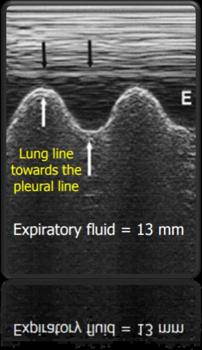 Figure 4 — Epanchement pleural en mode temps-mouvement : le signe du sinusoide, la ligne pulmonaire se rapprochant de la ligne pleurale a l'inspiration.