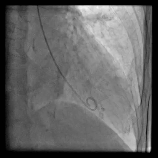 Figure 2 — Contrôle radioscopique peropératoire : le cathéter opaque, reconnaissable à sa boucle distale, se projette sur la silhouette cardiaque. La scopie confirme la position, mais c'est d'abord la forme de la courbe de pression qui signe chaque cavité franchie.