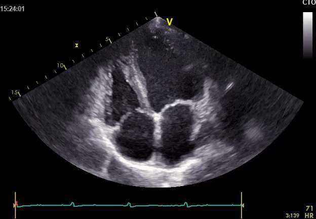 Figure 2 — Échocardiographie transthoracique 2D en coupe apicale : cavités ventriculaires dilatées à l'aspect globuleux, substrat morphologique de l'insuffisance cardiaque à fraction d'éjection réduite. En bas, le tracé électrocardiographique synchrone confirme un rythme sinusal régulier à 71 battements par minute — le contexte précis où le contrôle de la fréquence trouve son indication.