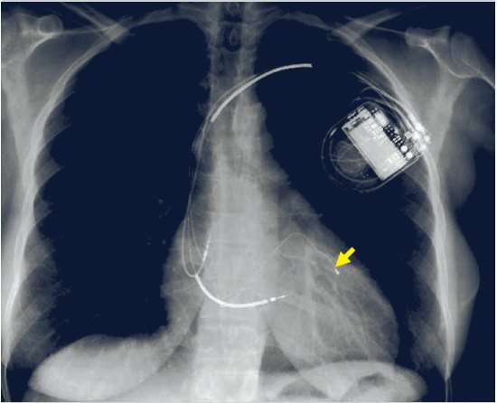 Figure 2 — N — Radiographie thoracique de face d'un défibrillateur implanté : boîtier en loge pré-pectorale gauche relié au cœur par une sonde endocavitaire, dont le segment radio-opaque épaissi correspond à la bobine de défibrillation dans le ventricule droit.