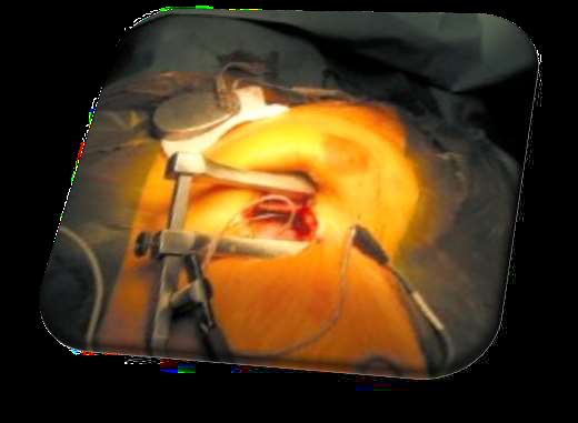 Figure 5 — N — Vue peropératoire de l'implantation : le générateur (boîtier) est déposé dans sa loge sous-cutanée pré-pectorale et raccordé à sa sonde, geste commun à tous les défibrillateurs implantés.
