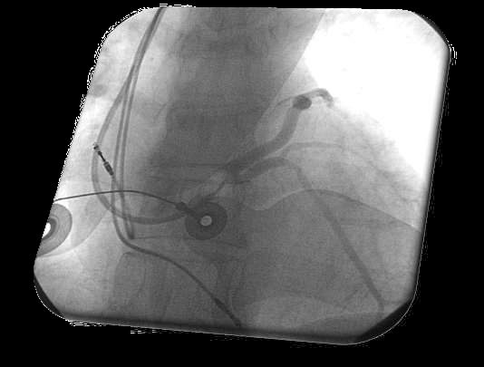 Figure 9 — Phlébographie rétrograde du sinus coronaire pendant l'implantation : un ballon d'occlusion opacifie l'arbre veineux coronaire pour repérer une veine latérale ou postéro-latérale exploitable. Cette anatomie veineuse commande le site accessible à la sonde ventriculaire gauche — et donc, pour une large part, la réponse au traitement.