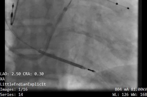 Figure 2 — Contrôle scopique en fin d'implantation d'un stimulateur triple chambre : les trois sondes sont en place — oreillette droite, ventricule droit (vers l'apex) et ventricule gauche amenée par le sinus coronaire jusque dans une veine latérale, en position épicardique.