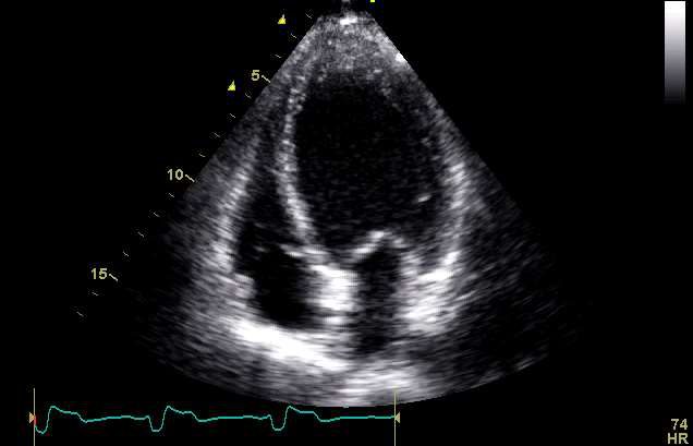 Figure 5 — Échocardiographie transthoracique, coupe apicale : ventricule gauche dilaté, expression du remodelage de l'insuffisance cardiaque à fraction d'éjection réduite ; c'est la régression des volumes de ce ventricule — le remodelage inverse — qui témoignera de l'efficacité de la resynchronisation.