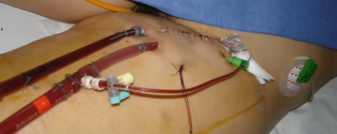 Figure 4 — Abord fémoro-fémoral d'une ECMO périphérique au pli de l'aine : les canules veineuse de drainage et artérielle de réinjection sont fixées par des points et des agrafes cutanées, avec un robinet à trois voies sur une ligne latérale ; c'est le site de canulation le plus courant.