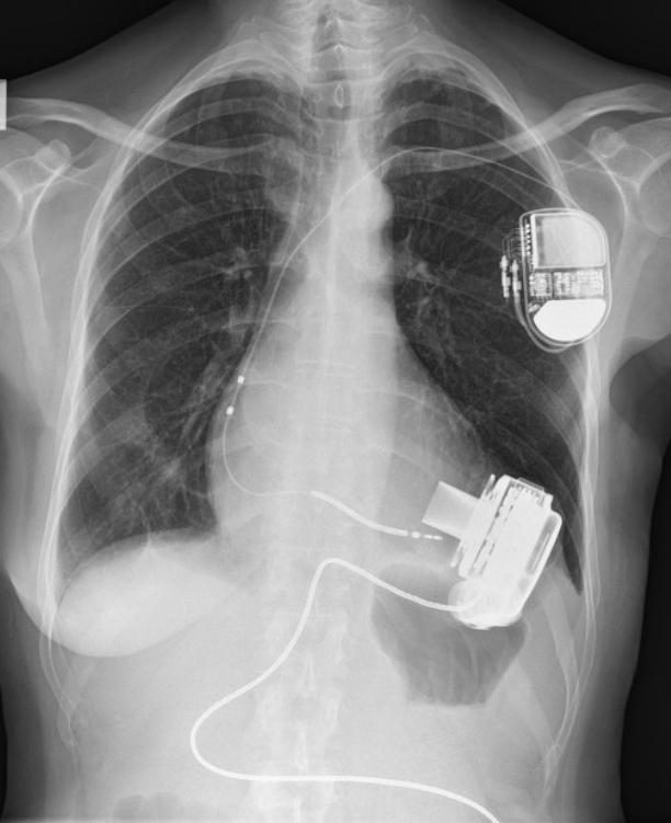 Figure 3 — Radiographie thoracique de face d'un patient sous assistance ventriculaire gauche : en region pectorale gauche, le boitier d'un defibrillateur implante et ses sondes transveineuses gagnant les cavites droites ; en projection de la pointe du coeur, la pompe d'assistance, volumineuse et radio-opaque, d'ou part la ligne d'activation qui chemine vers le flanc. Le montage complet se reconnait ainsi sur ce seul cliche de face.