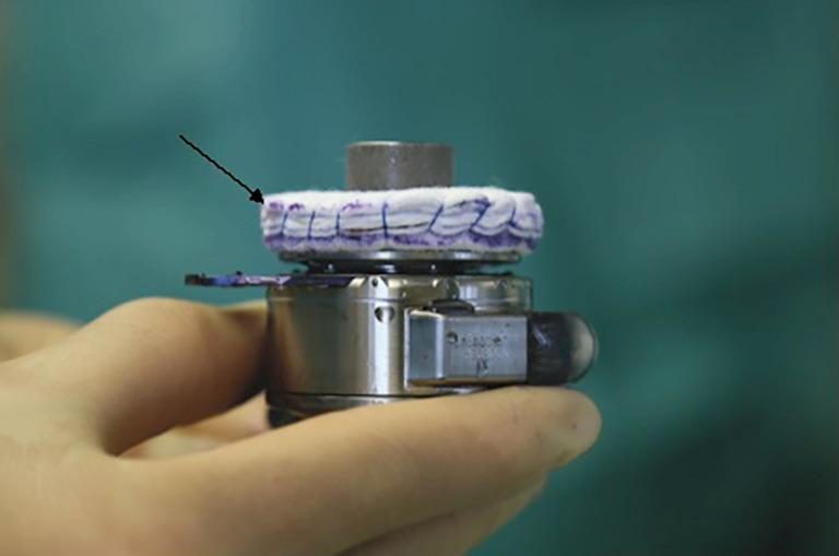 Figure 3 — Pompe d'assistance ventriculaire à flux continu, de type centrifuge, tenue entre les doigts sur un champ opératoire. La couronne de tissu clair qui coiffe le corps métallique est l'anneau de suture (flèche) : c'est par lui que la pompe est cousue au myocarde, du côté de l'entrée du sang, les traits au crayon chirurgical violet en repérant l'orientation d'implantation. Le boîtier métallique renferme le rotor et porte un numéro de série gravé. C'est ce type de pompe à flux continu, conçu et validé pour le ventricule gauche, autour duquel s'est construite l'assistance circulatoire de longue durée.