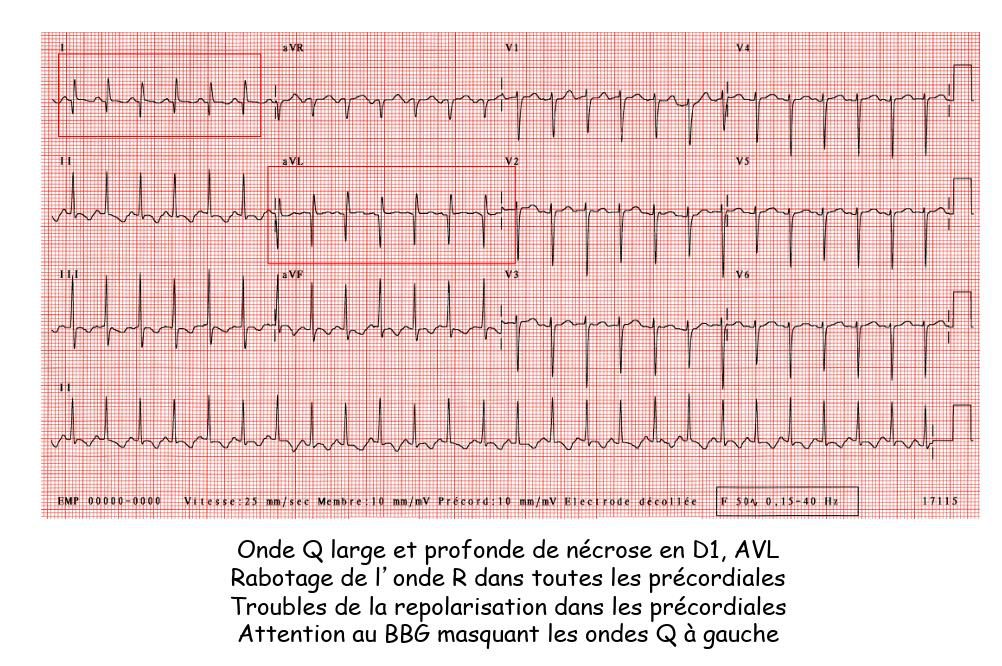 Figure 8 — Électrocardiogramme 12 dérivations d'un nourrisson porteur d'une ALCAPA (tracé anonymisé). Ondes Q larges et profondes de nécrose en D1 et aVL (encadrés), rabotage de l'onde R dans les précordiales et troubles de la repolarisation : signature d'un infarctus antéro-latéral. Obtenu en trente secondes, ce tracé redresse le diagnostic devant une cardiomégalie du nourrisson faussement étiquetée cardiomyopathie dilatée idiopathique. Piège : un bloc de branche gauche peut masquer les ondes Q à gauche.