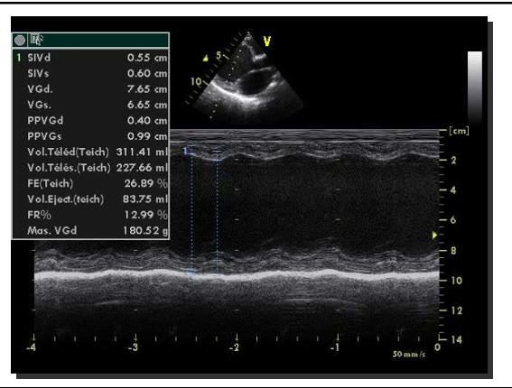 Figure 4 — Échocardiographie en mode temps-mouvement (TM) du ventricule gauche, voie parasternale, avec panneau de mesures Teichholz. Le ventricule est très dilaté — diamètre télédiastolique de 7,65 cm — et sa fonction effondrée : fraction de raccourcissement à 13 % et fraction d'éjection calculée à 27 %. Aspect typique de cardiomyopathie dilatée hypokinétique. Chez l'enfant, de tels diamètres se rapportent toujours à la surface corporelle (Z-score) avant d'être interprétés.
