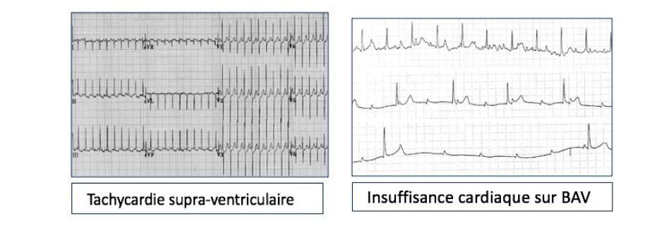Figure 6 — Deux troubles du rythme et de conduction responsables d'insuffisance cardiaque chez l'enfant. À gauche, tachycardie supraventriculaire : tachycardie régulière à QRS fins qui, incessante et longtemps bien tolérée, aboutit en quelques semaines à une cardiomyopathie rythmique réversible après réduction. À droite, insuffisance cardiaque sur bloc auriculo-ventriculaire : la bradycardie prive le ventricule de son débit — rappel que, chez le nouveau-né, le débit dépend avant tout de la fréquence.