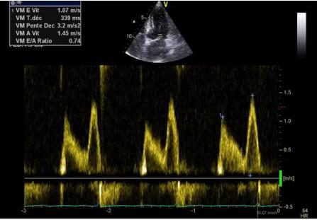 Comparaison de deux tracés Doppler de remplissage mitral, l'un jeune avec onde E dominante, l'autre âgé avec onde E diminuée et onde A augmentée, et schéma de la part du remplissage assurée par l'oreillette.