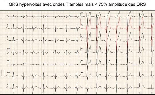 Figure 6 — ECG 12 dérivations avec bande de rythme en D2 : QRS de haut voltage et ondes T amples prédominant dans les dérivations précordiales (complexes de V2 surlignés en rouge). L'annotation rappelle que ces ondes T, bien qu'amples, restent inférieures à 75 % de l'amplitude du QRS — un repère qui les distingue des ondes T pointues, symétriques et à base étroite qui ouvrent la séquence électrocardiographique de l'hyperkaliémie.
