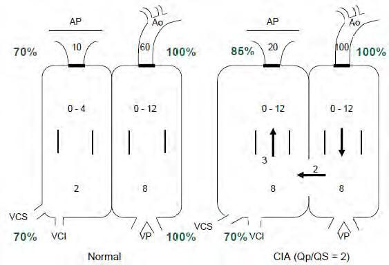 Figure 1 — Le shunt gauche-droite et le rapport des débits. À gauche, la circulation normale ; à droite, une communication interauriculaire dont le débit pulmonaire vaut deux fois le débit systémique. Ce rapport se lit ici sur les saturations, par l'équation de Fick : (100 − 70) / (100 − 85) = 2 — les chiffres portés sur les flèches ne sont qu'indicatifs et ne doivent pas être recalculés. Regardez d'abord la saturation des cavités droites, remontée de 70 à 85 % parce que du sang déjà oxygéné y revient : c'est le fondement de l'oxymétrie étagée. Regardez ensuite la pression artérielle pulmonaire : elle passe de 10 à 20 mmHg quand le débit double, alors que la pression aortique en regard se compte en dizaines. Le lit pulmonaire encaisse le débit sans jamais passer en régime systémique — c'est toute la tolérance de la CIA, et la raison pour laquelle l'Eisenmenger y est rare.