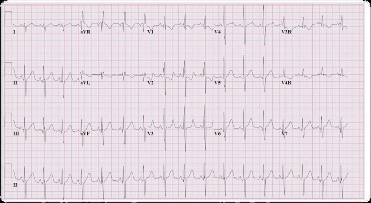 Figure 4 — Signature électrique de la surcharge volumétrique droite. Cherchez en V1 l'aspect rsR' : c'est un bloc de branche droit incomplet, et l'amplitude de R' suit grossièrement l'importance de la surcharge. L'axe de QRS est dévié à droite. Une déviation axiale gauche, à l'inverse, ferait évoquer un ostium primum.