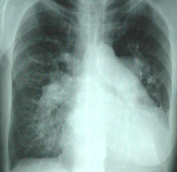 Figure 5 — Radiographie thoracique de face d'une communication interauriculaire à gros shunt chez l'adulte. Trois choses à voir, et dans cet ordre : une cardiomégalie par dilatation des cavités droites ; des hiles élargis, le tronc de l'artère pulmonaire et ses branches étant dilatés par l'hyperdébit ; et surtout une hypervascularisation artérielle qui s'étend jusqu'aux périphéries — suivez les opacités vasculaires jusque dans le tiers externe des champs pulmonaires, là où le poumon normal paraît vide. C'est ce signe, et non la seule taille du cœur, qui traduit le shunt. Chez l'adulte, c'est souvent ce type de cliché — demandé pour tout autre motif — qui déclenche le diagnostic.