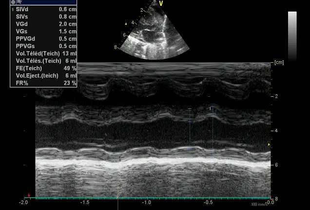 Figure 3 — Retentissement ventriculaire du petit nourrisson coarcté : mode temps-mouvement du ventricule gauche. Les dimensions sont encore normales pour l'âge (diamètre télédiastolique 20 mm) et la fonction systolique est modérément abaissée — fraction de raccourcissement 23 % pour une norme de 28 à 44 %, fraction d'éjection estimée à 49 %. C'est l'atteinte de pompe, non la dilatation, qui fait le tableau : le nouveau-né et le nourrisson coarctés ne se présentent pas avec un souffle, mais avec une défaillance de pompe.