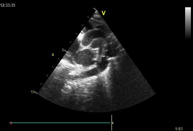 Figure 5 — Coupe suprasternale chez un patient à fenêtre médiocre : c'est le cas le plus fréquent en pratique. La crosse n'est pas déroulée — ni aorte ascendante, ni sommet de crosse, ni départ des troncs, ni aorte descendante identifiables — et le secteur descend à 10 cm alors qu'une crosse se lit entre 2 et 6 cm de profondeur. Cette image ne permet ni d'affirmer ni d'écarter une coarctation : elle impose de reprendre l'incidence, de passer au doppler couleur, puis, chez l'adulte, à l'imagerie en coupe. On ne conclut jamais sur une image que l'on ne sait pas lire.