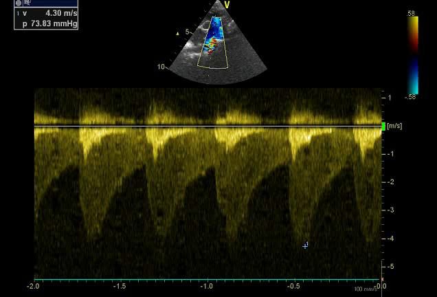 Figure 8 — Doppler continu dans l'isthme : enveloppe systolique de haute vitesse, 4,30 m/s pour un gradient maximal de 74 mmHg. Le signe décisif n'est pas ce chiffre, mais le prolongement du signal en diastole — la vitesse ne revient pas à la ligne de base : c'est la queue diastolique d'une coarctation serrée.