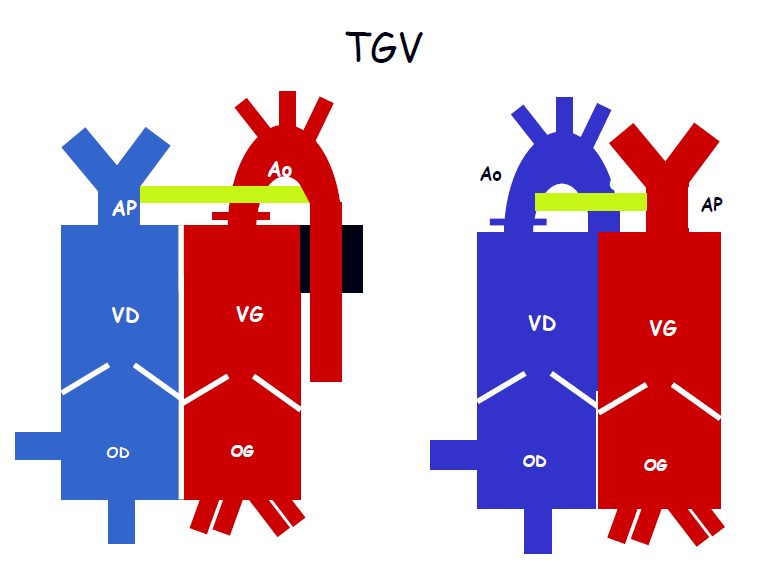 Figure 1 — Discordance ventriculo-artérielle. À gauche le cœur normal : artère pulmonaire née du ventricule droit, aorte née du ventricule gauche. À droite la transposition : aorte née du ventricule droit, artère pulmonaire née du ventricule gauche. La bande jaune marque le plan des valves artérielles, c'est-à-dire la connexion qui change. Le croisement des deux troncs, qui est un rapport avant-arrière, n'est pas rendu par ce schéma vu de face : c'est en échographie qu'on le cherche, par l'enroulement en petit axe.