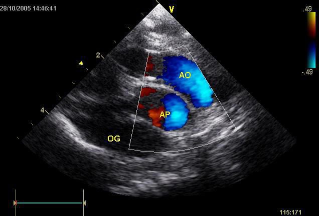 Figure 4 — Doppler couleur à la base chez un nouveau-né transposé : les deux gros vaisseaux, aorte (AO) en avant et à droite et artère pulmonaire (AP) en arrière et à gauche, sont côte à côte et montent parallèlement, remplis d'un même flux antérograde qui s'éloigne de la sonde — c'est l'aspect en canon de fusil. Aucun enroulement de l'artère pulmonaire autour de l'aorte n'est obtenable. Oreillette gauche (OG) en arrière.