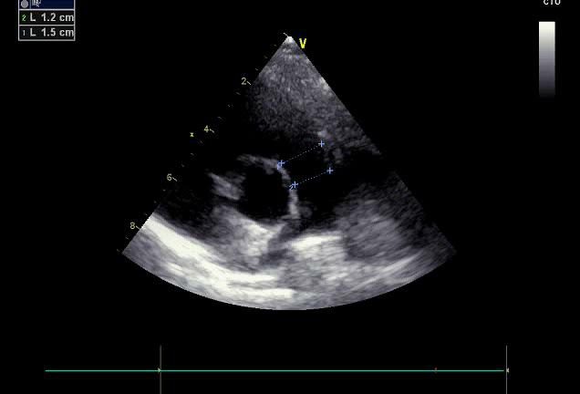 Figure 1 — Parasternale petit axe des gros vaisseaux : le tronc de l'artère pulmonaire se divise en deux branches, ici suivies et mesurées à 1,5 et 1,2 centimètres. C'est cette division, et non la position du vaisseau, qui identifie l'artère pulmonaire — l'aorte, elle, ne se divise pas : elle donne les coronaires. Anneau, tronc et branches se mesurent en systole.