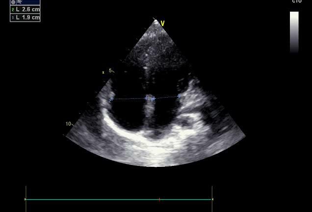 Figure 5 — Apicale quatre cavités : deux diamètres transverses sont mesurés sur une même ligne, de part et d'autre du septum, à 2,6 cm et 1,9 cm. C'est la balance ventriculaire — un rapport, donc un chiffre lisible sans table de référence. Mais il se juge autant qu'il se mesure : 2,6 sur 1,9 fait 1,4, soit près de 40 % d'asymétrie entre les deux ventricules, ce qui n'est pas une balance normale. Lequel est le droit ? L'image n'étant pas annotée, seule la morphologie — bande modératrice, insertion plus apicale de la valve — permet de le dire ; jamais le côté de l'écran.