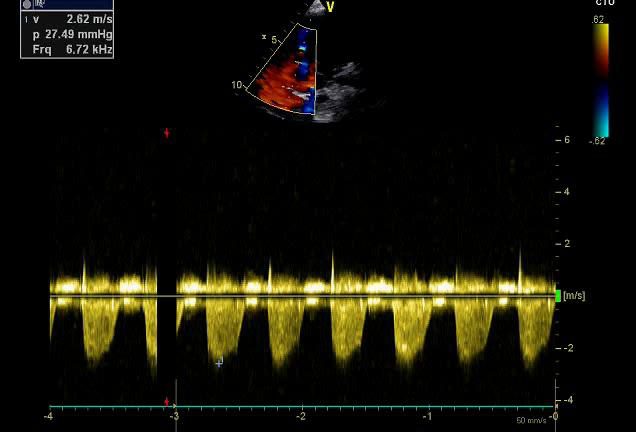 Figure 8 — Doppler continu du flux d'insuffisance tricuspide, guidé par le doppler couleur : vitesse maximale 2,62 mètres par seconde, soit un gradient systolique entre ventricule droit et oreillette droite de 27,5 mmHg. En ajoutant la pression de l'oreillette droite et en l'absence d'obstacle pulmonaire, on obtient la pression artérielle pulmonaire systolique.