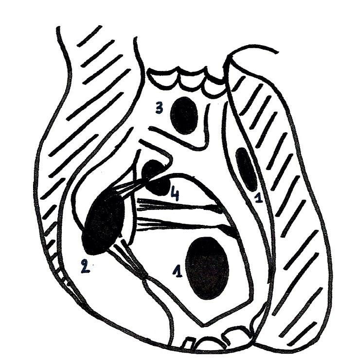 Figure 3 — Les quatre sièges du défaut, sur une coupe frontale du cœur. Repérez les numéros : 1 désigne les défauts du septum musculaire trabéculé, ici l'un haut et l'autre apical ; 2, le défaut d'admission, au contact de l'appareil valvulaire auriculo-ventriculaire ; 3, le défaut de la voie d'éjection, haut, immédiatement sous les sigmoïdes ; 4, le défaut périmembraneux, au point de convergence des trois autres composants. Attention à ce que ce schéma dit et à ce qu'il ne dit pas : il donne le siège, rien de plus. La nature des berges — muscle ou tissu fibreux — ne se lit pas sur un dessin au trait, où les cinq défauts sont figurés par des ovales identiques ; elle se déduit du siège et de l'échographie. Et c'est elle, non le numéro, qui commande la fermeture spontanée.