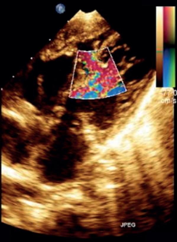 Figure 5 — La même image, en Doppler couleur. La boîte couleur est posée sur la région que désignait la flèche de la figure précédente : le jet en mosaïque rose-vert-bleu y apparaît, naissant du ventricule gauche pour s'épanouir dans le ventricule droit. Deux choses à voir. La mosaïque d'abord, qui signe un flux turbulent à haute vitesse, donc un gradient conservé, donc un défaut restrictif. Et surtout le fait que cette couleur soit ici la vraie preuve du défaut : le cliché bidimensionnel seul, à la figure précédente, ne permettait pas de conclure. Retenez qu'un jet aussi bruyant en couleur est un jet rassurant — c'est le shunt discret, à vitesse basse, qui doit inquiéter.