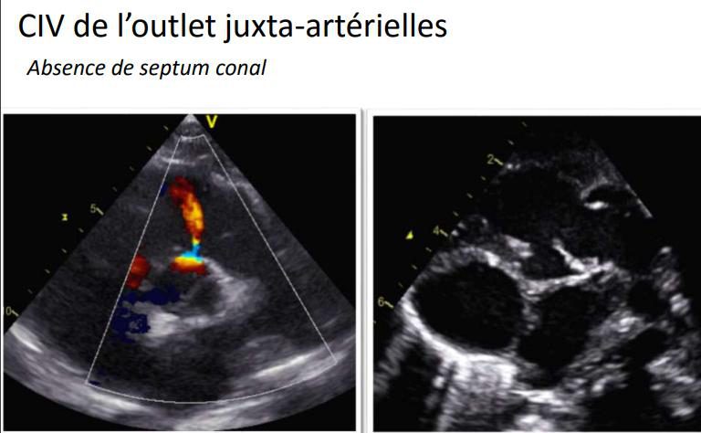 Figure 6 — Communication interventriculaire de la voie d'éjection, juxta-artérielle, par absence du septum conal. À gauche, le Doppler couleur montre une colonne de flux ascendante dans la voie d'éjection avec un foyer d'aliasing à sa base : le jet siège immédiatement sous les valves sigmoïdes. À droite, la coupe petit axe au niveau des gros vaisseaux montre les deux valves artérielles devenues adjacentes, sans septum conal interposé entre elles. C'est cette contiguïté qui donne au défaut un toit fibreux — donc l'impossibilité de se fermer seul et le risque de prolapsus de la cuspide aortique.