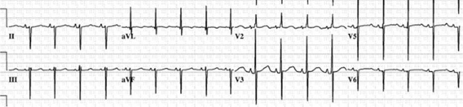 Figure 4 — L'électrocardiogramme d'un canal atrio-ventriculaire partiel. Regardez les dérivations frontales inférieures : en D2, en D3 et en aVF, les complexes sont profondément négatifs, alors qu'en aVL ils sont franchement positifs — c'est la déviation axiale gauche, ici franchement supérieure. Ce profil est l'inverse de celui d'une communication interauriculaire ostium secundum, qui donne un axe droit. Une précision sur ce que ce cliché ne montre pas : il s'agit d'un recadrage de deux bandes seulement — D2, aVL, V2 et V5 en haut ; D3, aVF, V3 et V6 en bas. D1, aVR, V1 et V4 n'y figurent pas, et le retard droit avec aspect rsR' en V1, décrit dans le texte, n'est donc pas vérifiable ici. Cela ne retire rien au message : devant un enfant étiqueté communication interauriculaire, ce sont bien D2, D3 et aVF qu'il faut regarder en premier. Des QRS négatifs dans ces trois dérivations imposent de chercher la fente de la valve auriculo-ventriculaire gauche, et interdisent d'emblée toute idée de fermeture percutanée.