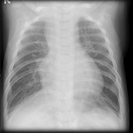 Figure 5 — Radiographie de thorax de face chez un enfant porteur d'un canal atrio-ventriculaire partiel. Deux éléments à voir, et ils vont ensemble : une silhouette cardiaque augmentée de volume, et une vascularisation pulmonaire trop visible, dont les branches se suivent loin dans les champs pulmonaires. Une précaution avant de conclure, et elle vaut pour tous les clichés de cet âge : l'ombre du thymus élargit normalement le médiastin supérieur, comme ici — ce n'est donc pas ce bord-là qu'il faut juger, mais le bord inférieur et le bord gauche du cœur. C'est l'image de tout shunt gauche-droite à gros débit : elle ne dit ni le type de communication, ni l'état de la valve. Ce cliché n'est pas un examen diagnostique, mais il est souvent celui qui alerte, parce qu'il est demandé pour autre chose.