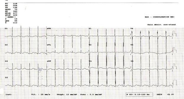 Figure 3 — Électrocardiogramme d'un shunt gauche-droite large. Rythme sinusal à 118/min : attention à la norme, car une fréquence cardiaque ne s'interprète jamais sans l'âge — chez le nourrisson elle va normalement de 100 à 160/min, et 118 y est une fréquence normale ; ce n'est que chez le grand enfant et l'adulte que ce chiffre devient une tachycardie. Conduction normale (PR 136 ms), QRS fins (70 ms), axe QRS +55°. Ce qu'il faut voir : les précordiales sont enregistrées à demi-étalonnage — 5 mm/mV contre 10 mm/mV aux périphériques, mention « Gain dériv. non-stand » — et les déflexions restent pourtant très amples de V1 à V6, débordant sur les dérivations voisines. Des amplitudes qui débordent encore à la moitié du gain signent une surcharge ventriculaire majeure. Leçon annexe, valable partout : lisez l'étalonnage avant de juger une amplitude.