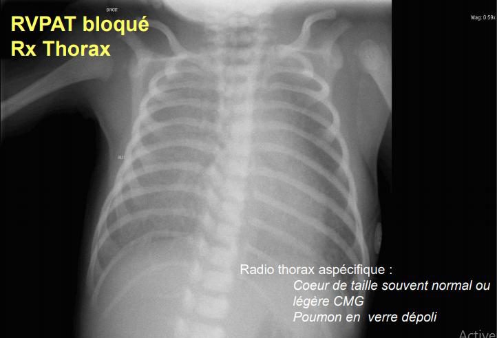 Figure 5 — Radiographie de thorax d'un nouveau-né porteur d'un retour veineux pulmonaire anormal total bloqué (diapositive du cours, « RVPAT bloqué — Rx Thorax »). Les deux champs pulmonaires sont diffusément voilés, en verre dépoli, jusqu'aux périphéries. Mais regardez la silhouette cardiaque : elle est de taille normale, ou à peine augmentée — c'est ce qu'énonce le texte même de la diapositive. C'est cette discordance — poumon inondé, cœur non dilaté — qui doit faire évoquer un obstacle sur le retour veineux, et non une cardiopathie à gros débit.
