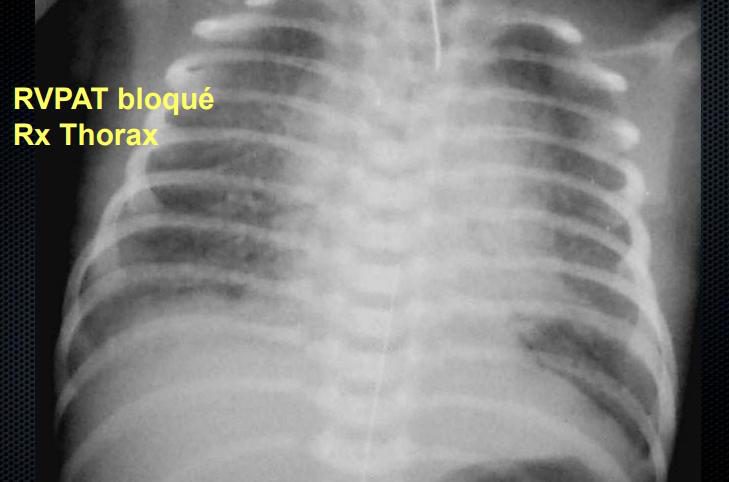 Figure 6 — Second cliché de la même diapositive du cours (« RVPAT bloqué — Rx Thorax ») : celui qui fait porter à tort le diagnostic de maladie des membranes hyalines. Opacités réticulo-granulaires diffuses et bilatérales, poumon peu aéré, aspect granité superposable à celui d'un déficit en surfactant, chez un nouveau-né traversé en ligne médiane par un fin cathéter. Devant ce cliché, la question à se poser n'est pas « quelle FiO2 ? » mais « où sont les quatre veines pulmonaires ? ».