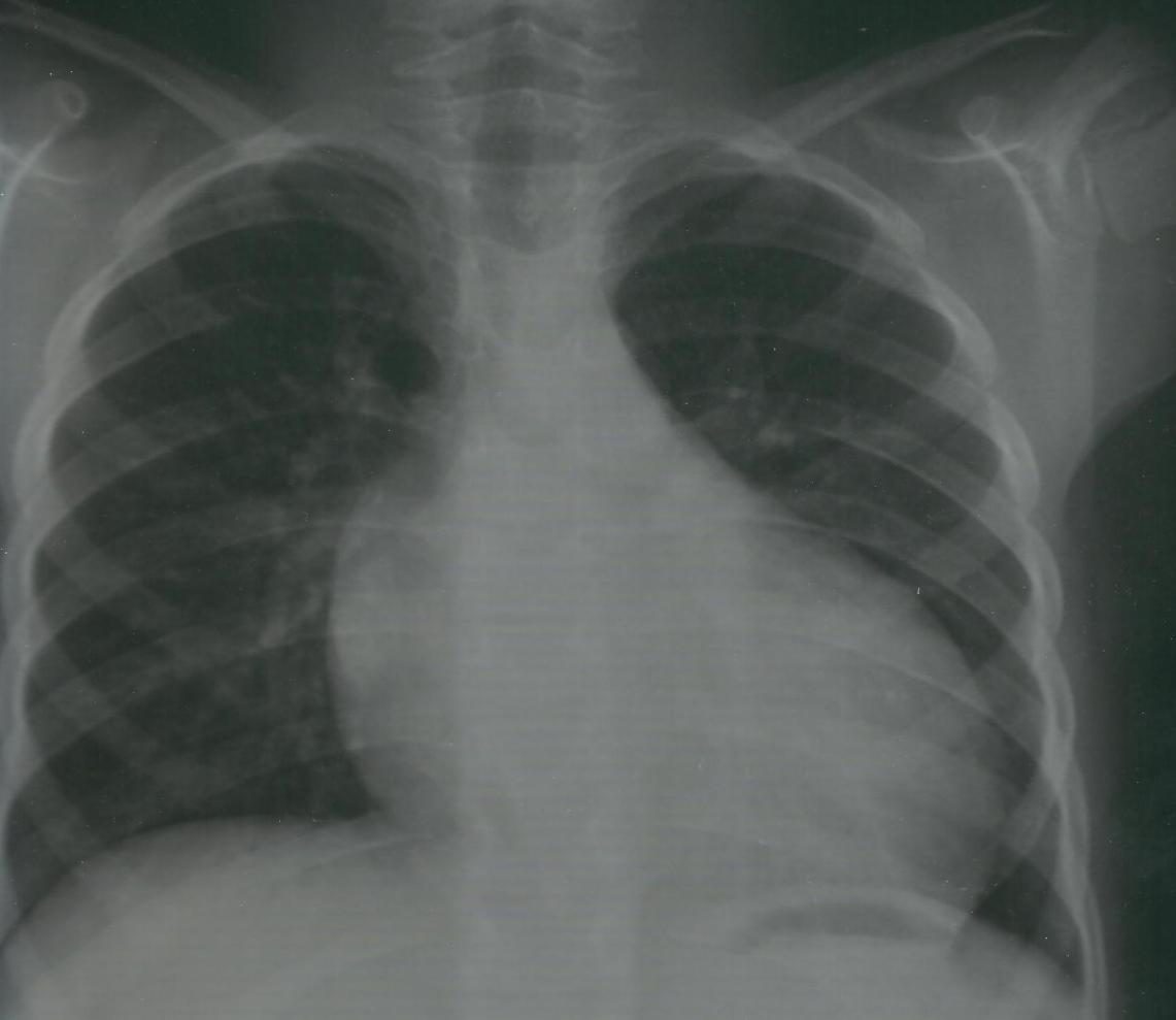 Figure 3 — Radiographie de thorax de face. Attention à l'âge : la maturité des clavicules et de la ceinture scapulaire montre qu'il s'agit d'un grand sujet, et non du nourrisson de deux à quatre mois — la forme tardive de la maladie existe, et donne la même image. Ce qu'il faut voir : une cardiomégalie franche, avec index cardiothoracique très augmenté, arc inférieur gauche débordant et pointe abaissée. C'est tout ce que le cliché apporte, et c'est déjà beaucoup : ce film est presque toujours réalisé avant le diagnostic, pour un motif respiratoire. Lu comme une pneumopathie, il fait perdre des semaines ; lu comme une cardiomégalie, il conduit à l'échographie. En revanche, la redistribution vasculaire vers les sommets, souvent décrite dans la surcharge veineuse pulmonaire, n'est pas objectivable sur ce cliché argentique numérisé : ne la cherchez pas ici.