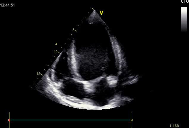 Figure 4 — Échocardiographie, coupe apicale quatre cavités. Regardez d'abord l'échelle : le secteur descend à 15 centimètres, il ne s'agit donc pas du cœur d'un nourrisson mais d'un sujet plus grand. Le ventricule gauche est dilaté, mais ce n'est pas ce qu'il faut regarder ici : observez la brillance anormale de l'endocarde et de l'appareil mitral, qui tranchent en blanc, presque calcaires, sur le gris du myocarde. C'est la traduction échographique de la fibroélastose endocardique et de l'ischémie chronique. Deux précautions avant de conclure : cette brillance se juge en temps réel, avec un gain réglé normalement, et par comparaison avec le myocarde voisin — un arrêt sur image trop gagné la fabrique. Cela dit, la règle demeure : un pilier blanc chez un enfant en insuffisance cardiaque est une anomalie coronaire jusqu'à preuve du contraire.