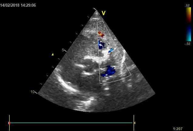 Figure 5 — Doppler couleur sur la paroi ventriculaire : les collatérales intramyocardiques. La boîte couleur est volontairement étroite et posée sur le muscle. On y distingue deux foyers de flux nettement séparés, chacun de petite taille et bien délimité — un foyer superficiel mêlant rouge et bleu, un foyer bleu plus profond — entourés d'un myocarde dont l'échostructure reste lisible. C'est cet aspect ponctué et discret, au sein de l'épaisseur du muscle, qui traduit la circulation collatérale développée pour suppléer le territoire gauche. Deux conditions pour lire cette image sans se tromper. D'abord, l'échelle de vitesse est basse — ± 0,58 m/s — parce que ces flux sont lents : c'est ce réglage qui les fait apparaître. Mais à une limite de Nyquist aussi basse, un flux de cavité parfaitement banal se replie lui aussi — c'est l'aliasing — et se colore en mosaïque : il faut donc repérer la limite entre cavité et myocarde avant d'attribuer un signal au muscle, et se méfier des nappes colorées larges et confluentes, qui sont des flux de cavité et non des collatérales. Ensuite, ce piqueté est un signe d'anomalie coronaire — et le piège classique est de le prendre pour une petite communication interventriculaire ou pour une fistule.