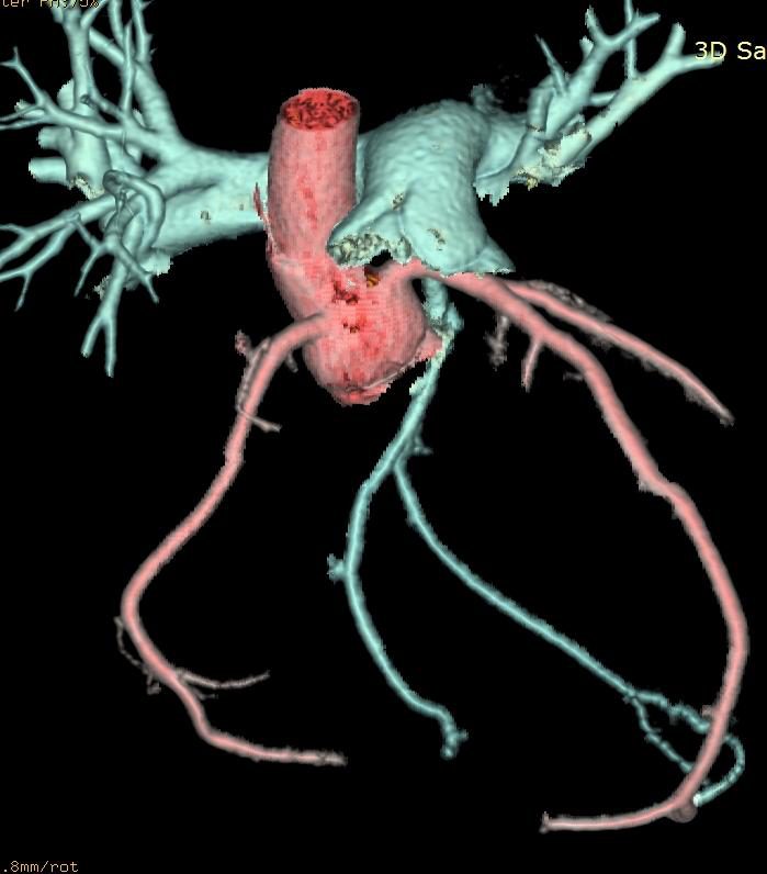 Figure 9 — Angioscanner coronaire, reconstruction volumique, vue antérieure. La racine et l'aorte ascendante, sectionnées, sont segmentées en rose ; le tronc et les branches de l'artère pulmonaire en bleu-vert. Deux réseaux coronaires épicardiques de gros calibre descendent sur les faces du cœur, l'un rattaché au versant aortique, l'autre au versant pulmonaire. Une précaution de lecture, qui vaut pour tout rendu volumique : la couleur est attribuée par la segmentation de l'opérateur ; elle guide l'œil, elle ne démontre pas à elle seule une continuité anatomique, et l'ostium lui-même n'est pas visible sous cet angle — c'est sur les coupes natives que se prouve la connexion de la coronaire gauche au tronc pulmonaire. Ce que l'image montre en revanche sans ambiguïté, c'est le calibre : des artères coronaires dignes de celles d'un adulte chez un enfant, signature de la circulation de suppléance.
