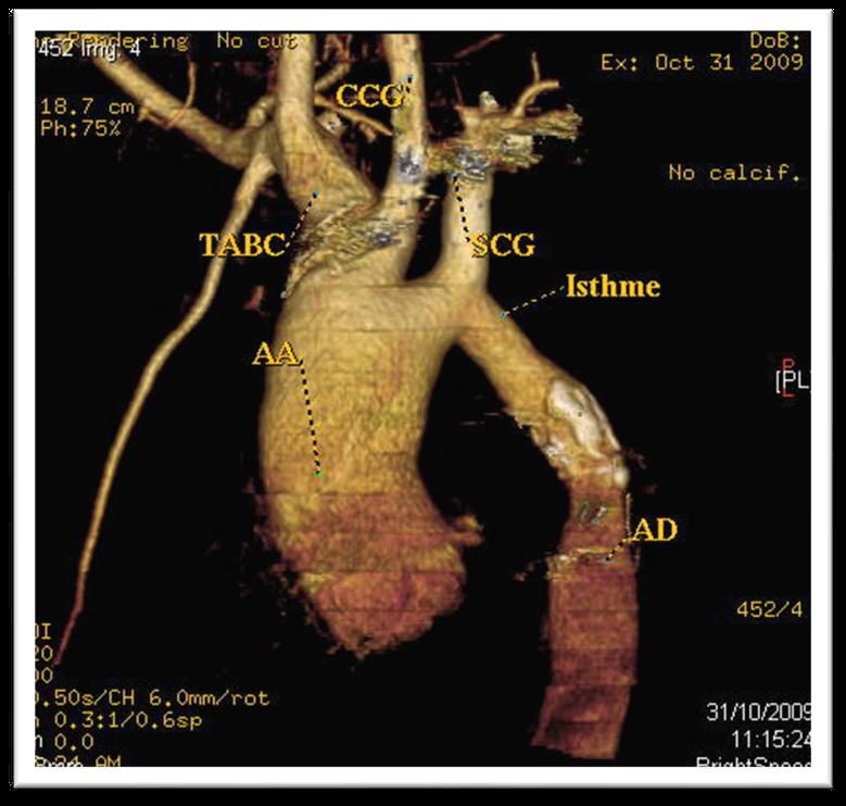 Figure 7 — Angioscanner de l'aorte thoracique en reconstruction tridimensionnelle, vue de profil, chez un patient coarcté. Suivez l'aorte ascendante puis les trois troncs de la crosse — tronc artériel brachio-céphalique, carotide commune gauche, sous-clavière gauche — jusqu'à l'isthme, repéré immédiatement en aval de la sous-clavière gauche : le calibre se réduit progressivement à ce niveau, le point le plus étroit se situant un peu au-dessous de la flèche, puis l'aorte se réélargit — dilatation post-sténotique — avant l'aorte descendante. Regardez aussi le contraste de calibre avec l'aorte ascendante, ici manifestement large : la coarctation s'accompagne très souvent d'une aortopathie, le plus souvent sur bicuspidie, et c'est elle qu'il faudra surveiller à vie. Retenez enfin la topographie, car c'est elle qui explique tout le reste : l'hypertension du territoire supérieur, l'asymétrie tensionnelle entre bras et jambes, et la circulation collatérale. (Cliché d'archive photographié à l'écran : la résolution est médiocre, mais les repères anatomiques restent lisibles.)